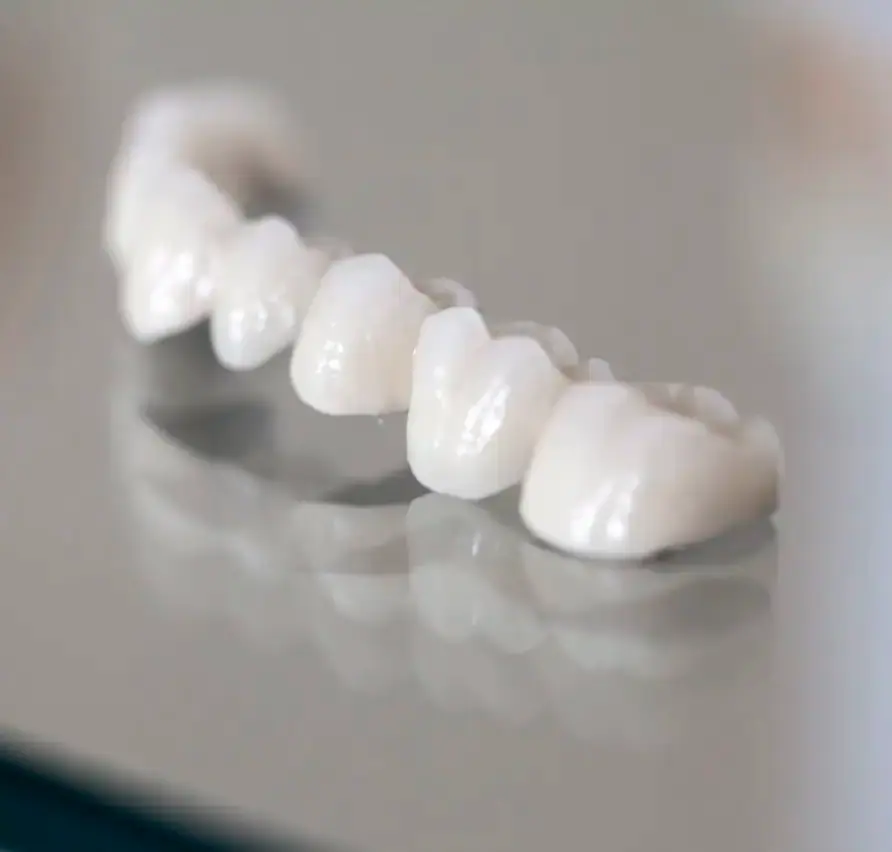 Zahnkrone und Zahnbrücke Wien – festsitzender Zahnersatz bei Dentalaesthetics 1010 Wien